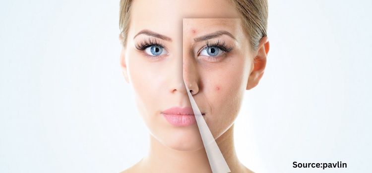 Breaking New Ground In Acne Treatment: Spotlight On The Top 5 Players