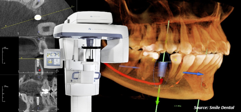 CBCT Industry Is Dominated By Dentsply Sirona, Philips, & Vatech With More Than 45% – Know Why