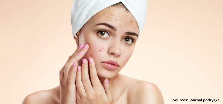 Acne Treatment Innovations: What’s Next in Skincare?